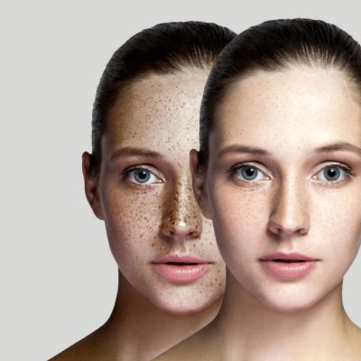 Facials skin peel-2